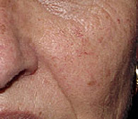 Brown spots before laser dermatology treatment - San Diego Dermatology and Laser Surgery