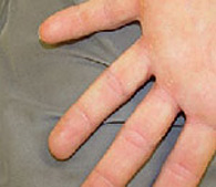 Wart on finger  after treatment - San Diego Dermatology and Laser Surgery