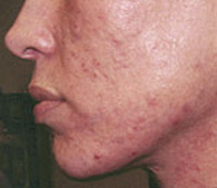 Acne and acne scars before treatment - San Diego Dermatology and Laser Surgery
