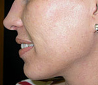 Acne and acne scars after treatment - San Diego Dermatology and Laser Surgery