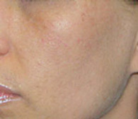 acne after treatment - San Diego Dermatology and Laser Surgery