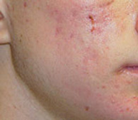 acne before treatment - San Diego Dermatology and Laser Surgery