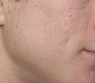 acne after treatment - San Diego Dermatology and Laser Surgery