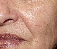 Brown spots after laser dermatology treatment - San Diego Dermatology and Laser Surgery