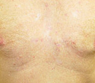 precancerous AK's after treatment - San Diego Dermatology and Laser Surgery