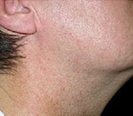 Redness on neck  after treatment - San Diego Dermatology and Laser Surgery