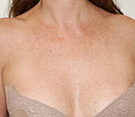 brown spots after treatment - San Diego Dermatology and Laser Surgery
