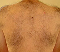 Soprano XL Hair Removal Laser before treatment - San Diego Dermatology and Laser Surgery