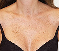 brown spots before treatment - San Diego Dermatology and Laser Surgery