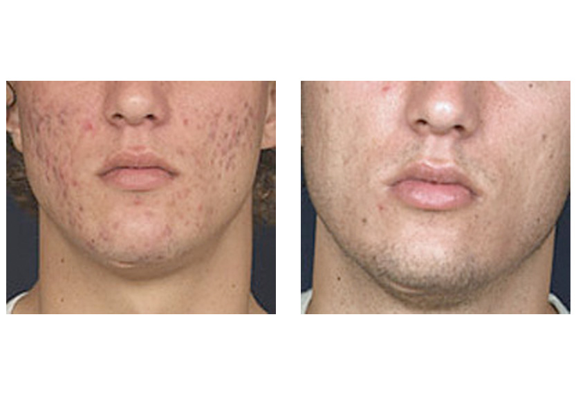 A variety of laser devices may be used to reduce acne and acne scarring. 
